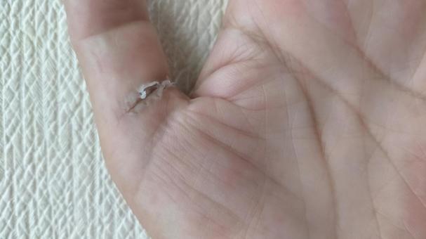 親指のバネ指-抜糸から5日後 親指のバネ指-抜糸から5日後 バネ指,バネ指の手術,手の手術の写真素材
