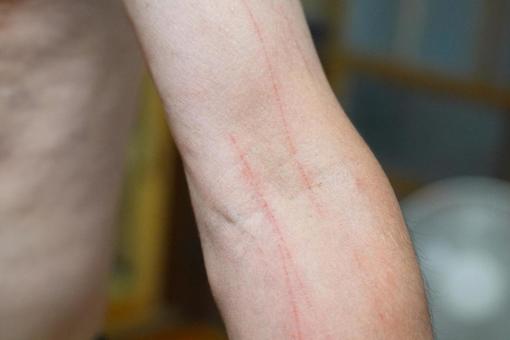 引っかき傷 引っかき傷,引っ掻く,手の写真素材