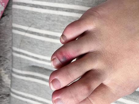 骨折した足の指 骨折した足の指 骨折,足の指,堕落した指の写真素材