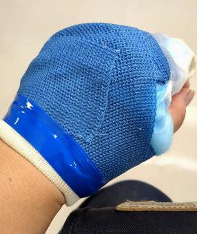 骨折 骨折 骨折,ギブス,左手の写真素材