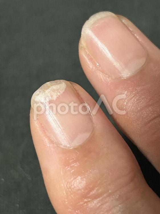 爪・割れる・二枚爪・ネイルで爪トラブル つめ,二枚爪,割れるの写真素材