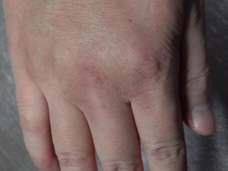 あかぎれ 手湿疹,手荒れ,アトピーの写真素材