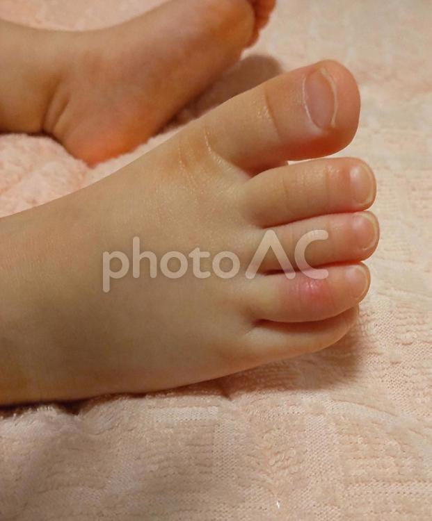 しもやけができた子供の足 子供,しもやけ,足の指の写真素材