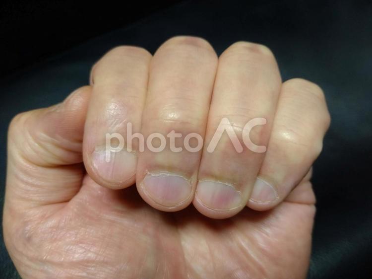 いびつな形のしじみ爪と甘皮の汚い手 しじみ,爪,手の写真素材