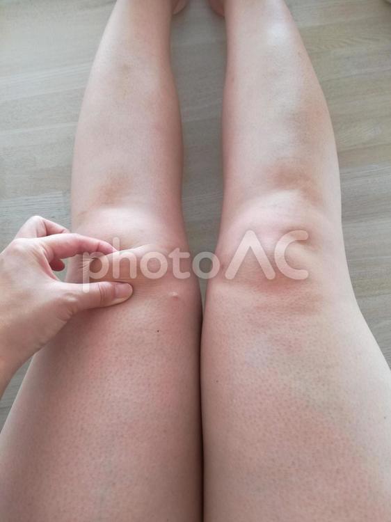 膝の上の肉　セルライト　脚　 脚,もも,太ももの写真素材