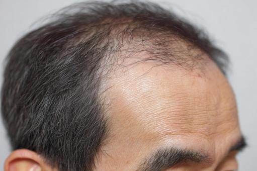 額の生え際が薄い中高年男性の頭部 額の生え際が薄い中高年男性の頭部の写真