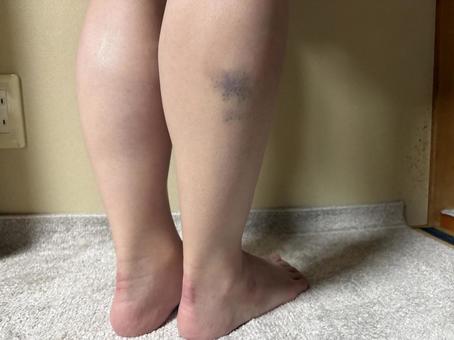 太いししゃも足の悩み 足,太い,ふくらはぎの写真素材