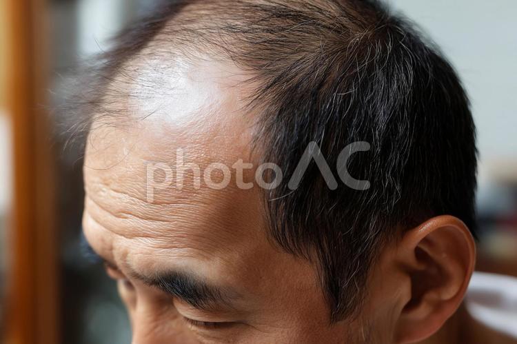 M字ハゲが目立つ中高年男性の横顔頭部 m字ハゲ,薄毛,男性の写真素材