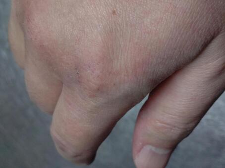 あかぎれ 手湿疹,手荒れ,アトピーの写真素材