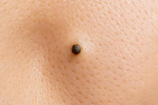 黒いほくろ・詰まり毛穴・皮膚トラブル 黒いほくろ・詰まり毛穴・皮膚トラブルの写真