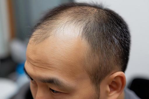 額の生え際を気にする若め男性の薄毛 額の生え際を気にする若め男性の薄毛の写真