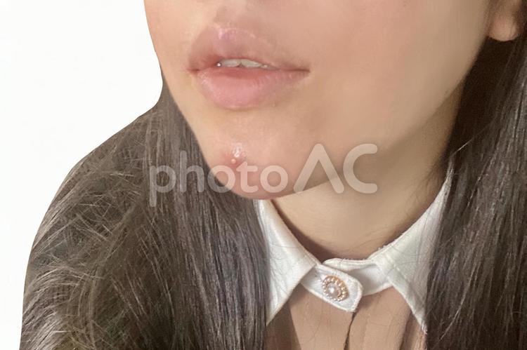 女性の顎に出来た白ニキビ　斜め顔 白ニキビ,ニキビ,吹き出物の写真素材