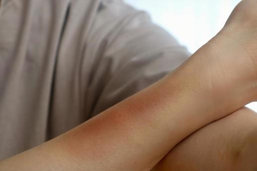 内出血のある女性の手 内出血のある女性の手 内出血,打撲,打ち身の写真素材