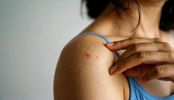 女性の二の腕にできた大きなおでき 女性の二の腕にできた大きなおできの写真