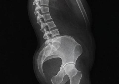 骨盤が後傾している骨格 骨盤が後傾している骨格の写真