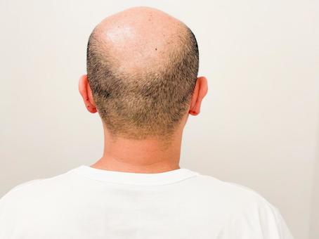 薄毛の男性の後ろ姿 薄毛,男性,髪の毛の写真素材