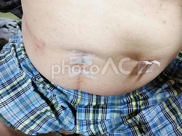 老人のビール腹と手術痕の事例 老人,高齢者,老化の写真素材