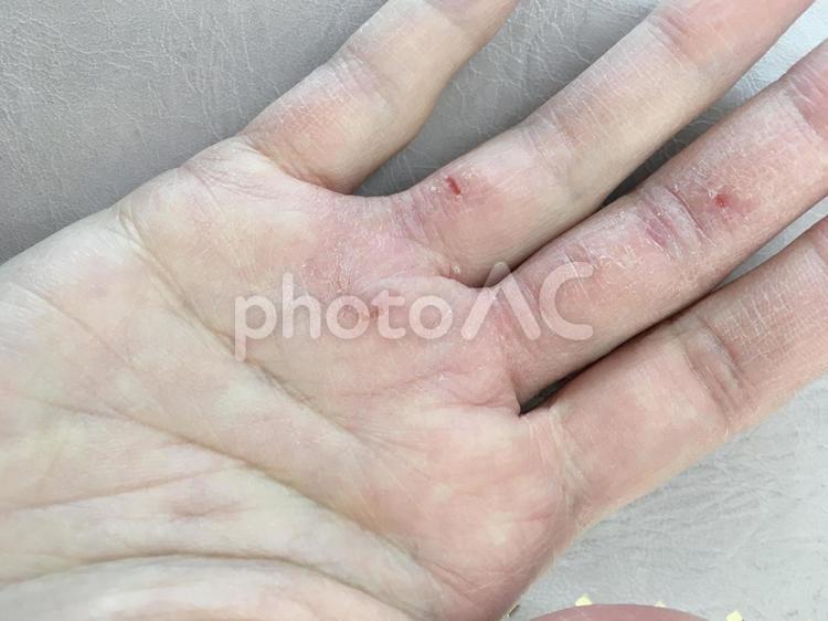 手荒れした女性の手 手荒れ,ひび割れ,あかぎれの写真素材