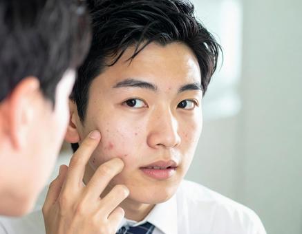 にきびができて困る男子 にきびができて困る男子の写真