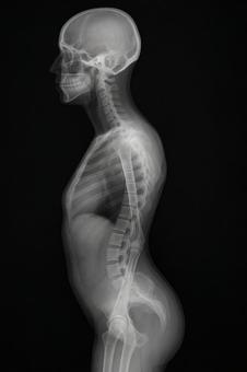 骨盤が前傾している反り腰の骨格 骨盤が前傾している反り腰の骨格の写真