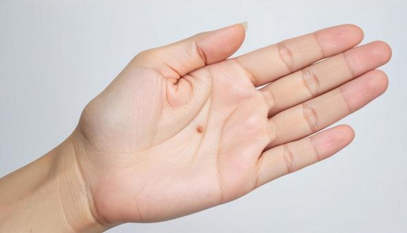 女性の手の平にできた大きなおでき 女性の手の平にできた大きなおできの写真