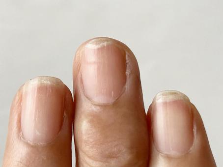Nails split due to overdoing it (side view), a catch, two claws, to break, JPG