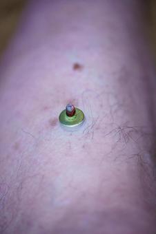 ツボへのお灸で体調を整える ツボへのお灸で体調を整える 東洋,ツボ,治療の写真素材