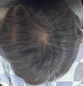 薄毛 頭,はげ,禿げの写真素材