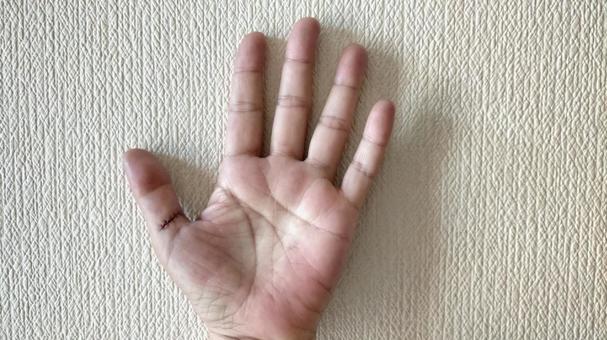 親指のバネ指-抜糸直後 親指のバネ指-抜糸直後 バネ指,バネ指の手術,手の手術の写真素材