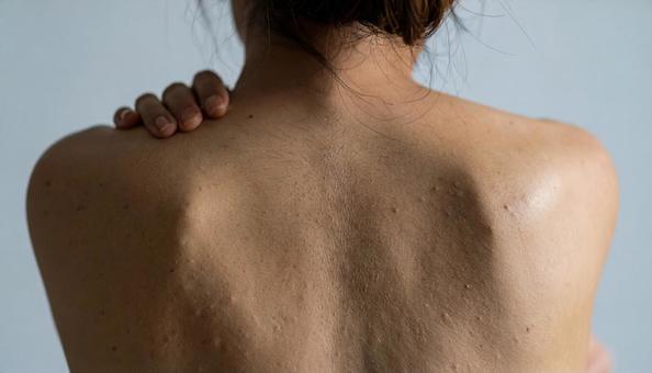 女性の背中にできた大きなおでき 女性の背中にできた大きなおできの写真