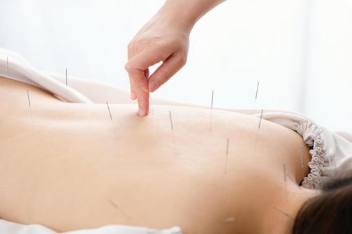 A woman with a needle stuck in her back at a bright acupuncture clinic, الوخز بالإبر, علاج, إبرة الوخز بالإبر, JPG