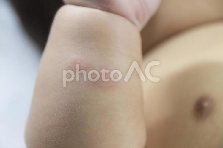 赤ちゃん  虫刺され 赤ちゃん,虫刺され,蚊の写真素材