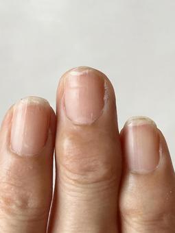 Nails split due to overdoing it (vertical), a catch, two claws, to break, JPG