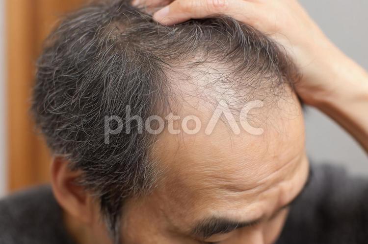 頭頂部を気にする中高年男性の薄毛 薄毛,男性,中高年の写真素材