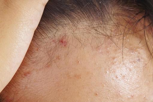 ニキビで悩む子供の肌 ニキビ,吹き出物,白ニキビの写真素材