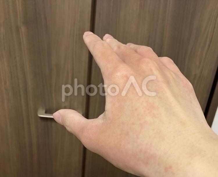 風呂上がりに手にできた発疹 手,発疹,痒いの写真素材