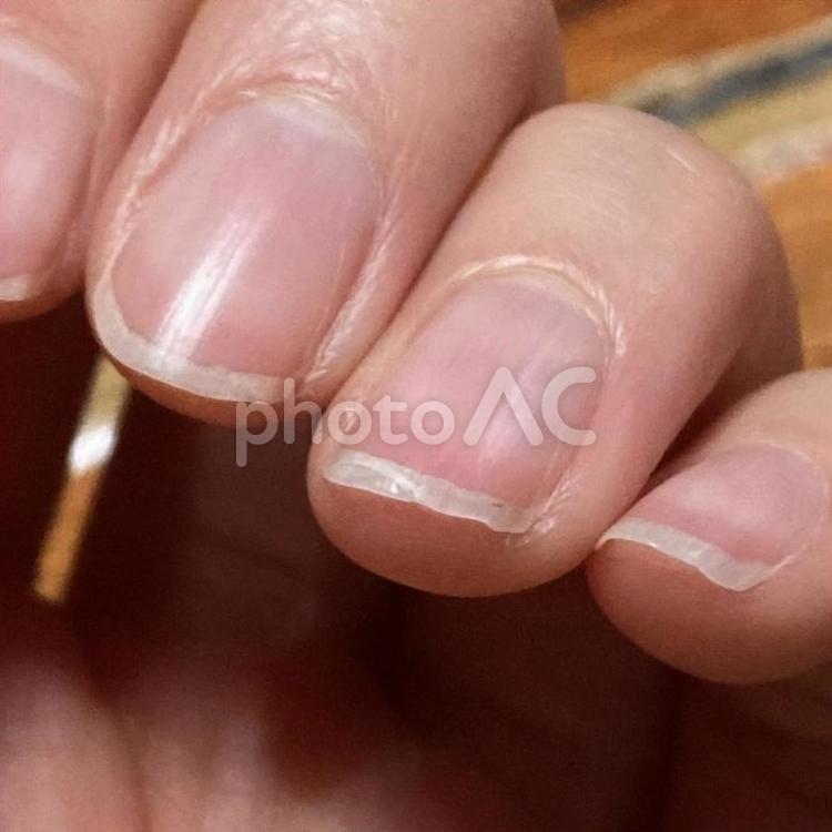 爪が割れてしまった 爪,指,つめの写真素材