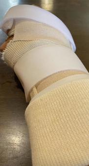 ギプスした腕 ギプスした腕 手,怪我,骨折の写真素材