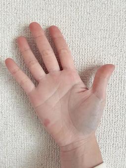 火傷した手のひら 火傷,油,皮膚の写真素材