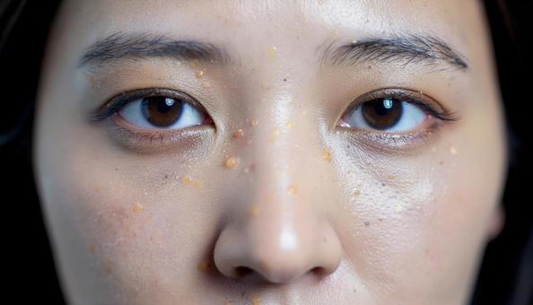 女性の目のまわりにできたブツブツ　稗粒腫の写真