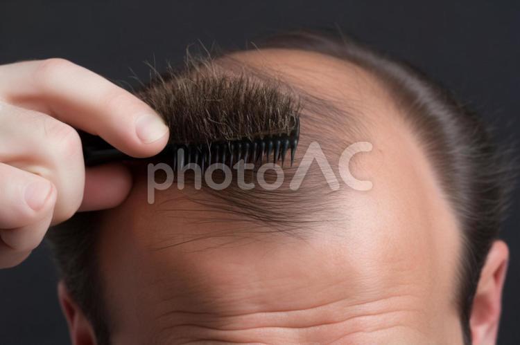 薄毛に悩む男性８ 薄毛,悩み,抜け毛の写真素材