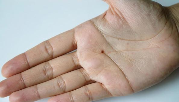 女性の手の平にできた大きなおでき 女性の手の平にできた大きなおできの写真