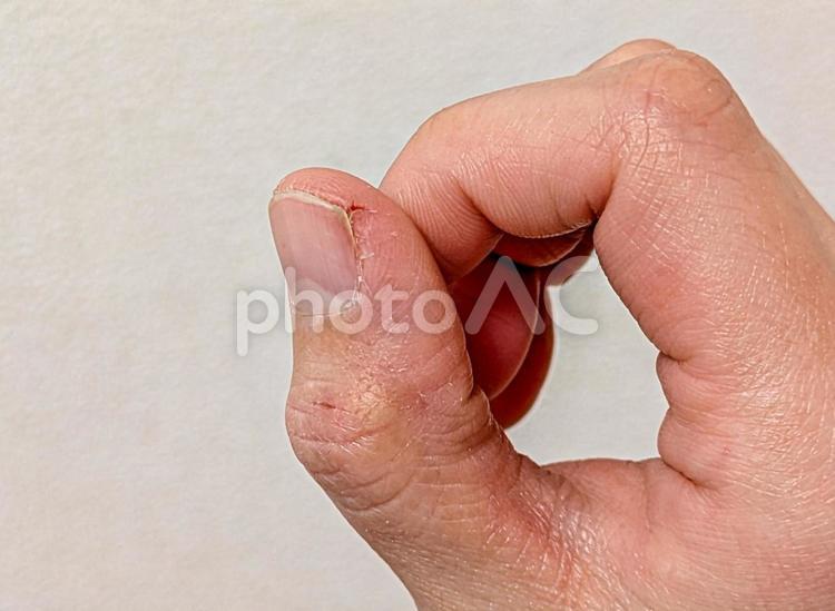 あかぎれした指先 あかぎれ,傷口,乾燥の写真素材