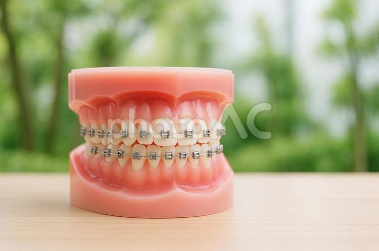 矯正器具をつけた歯形模型 矯正器具,歯形模型,ワイヤー矯正の写真素材