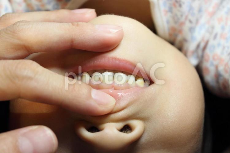 前歯の虫歯の進行止めのお薬 サホライド塗布 虫歯,歯医者,サホライドの写真素材