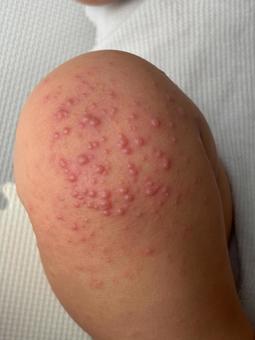 手足口病の水疱 手足口病の水疱 手足口病,発疹,皮膚の写真素材