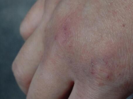 あかぎれ 手湿疹,手荒れ,アトピーの写真素材