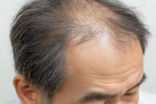頭頂部の薄毛が目立つ中高年男性 頭頂部の薄毛が目立つ中高年男性の写真