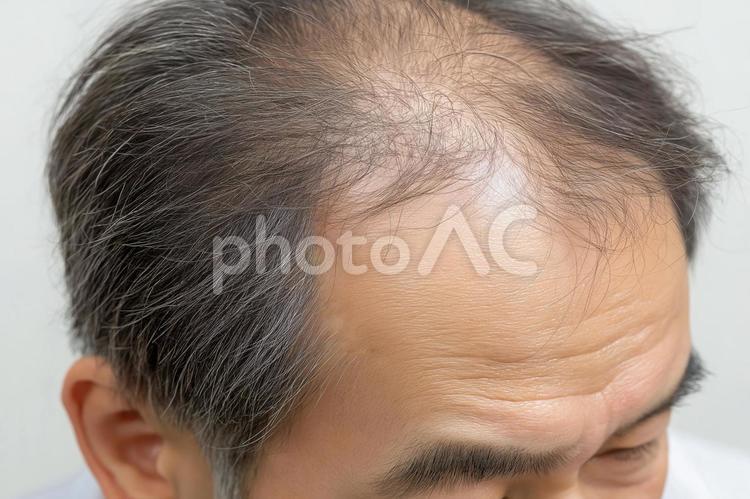 頭頂部の薄毛が目立つ中高年男性 薄毛,男性,中高年の写真素材