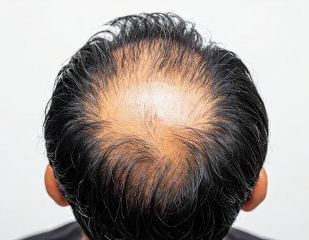 薄毛の頭 薄毛の頭の写真